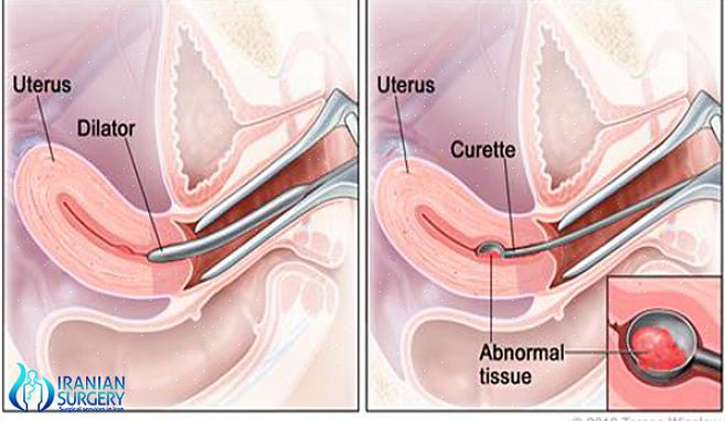 D&amp;C é uma pequena cirurgia que dura cerca de 10 a 15 minutos