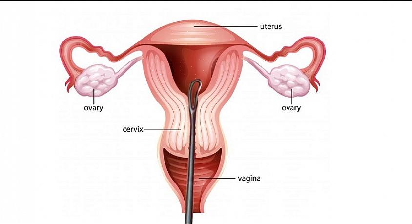 É importante entender por que as mulheres se submetem a procedimentos de D&amp;C ou qualquer tipo