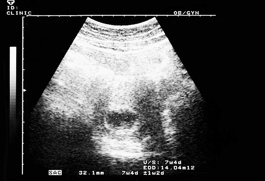 Pélvicos Os ultrassons da gravidez também são usados para diagnosticar problemas no útero
