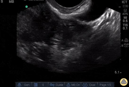 Problemas da placenta Os ultrassons da gravidez também podem ser usados para interpretar a localização