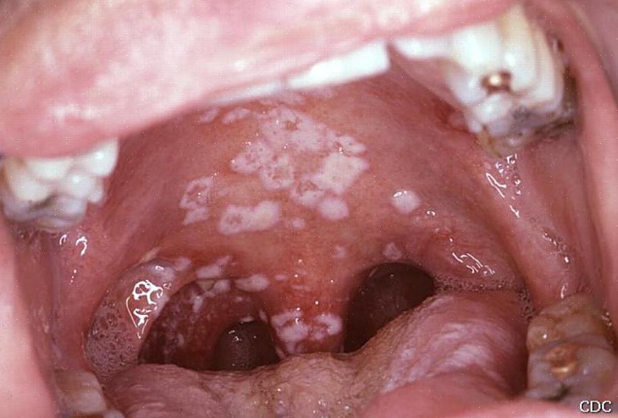 O sapinho é essencialmente uma infecção por fungos na boca