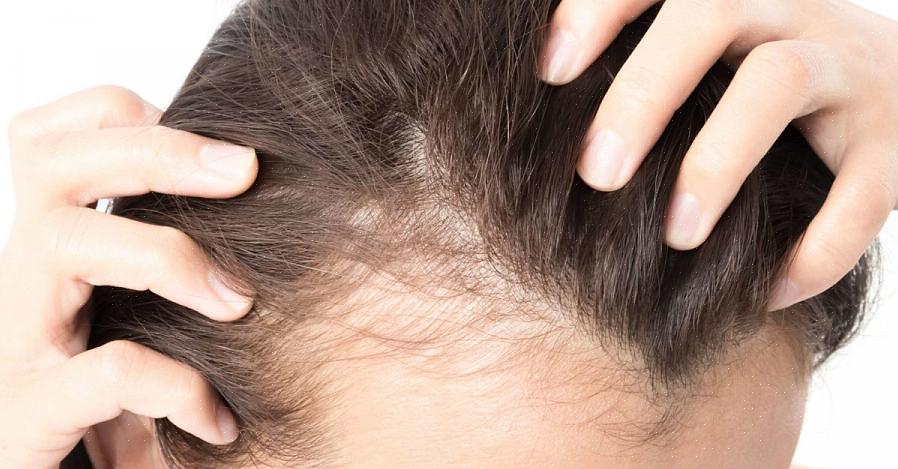 A alopecia é diferente da calvície de padrão masculino