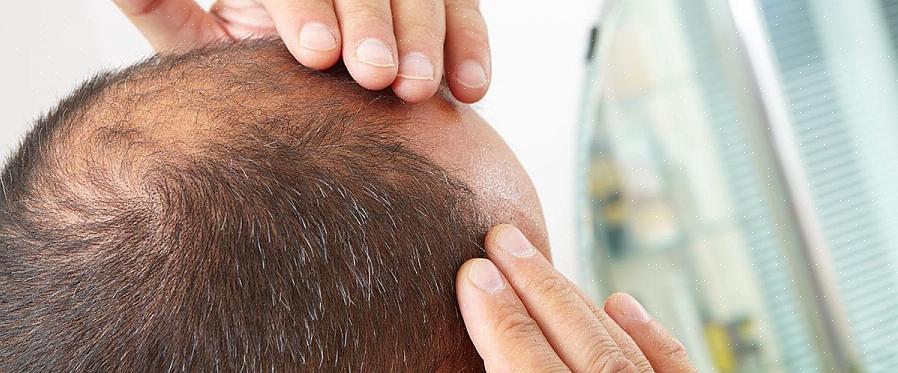 Mais homens estão raspando a cabeça em vez de mostrar que estão ficando carecas ou que têm cabelos ralos