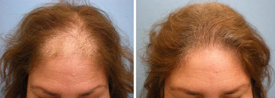 O futuro do tratamento contra queda de cabelo é cada vez mais brilhante