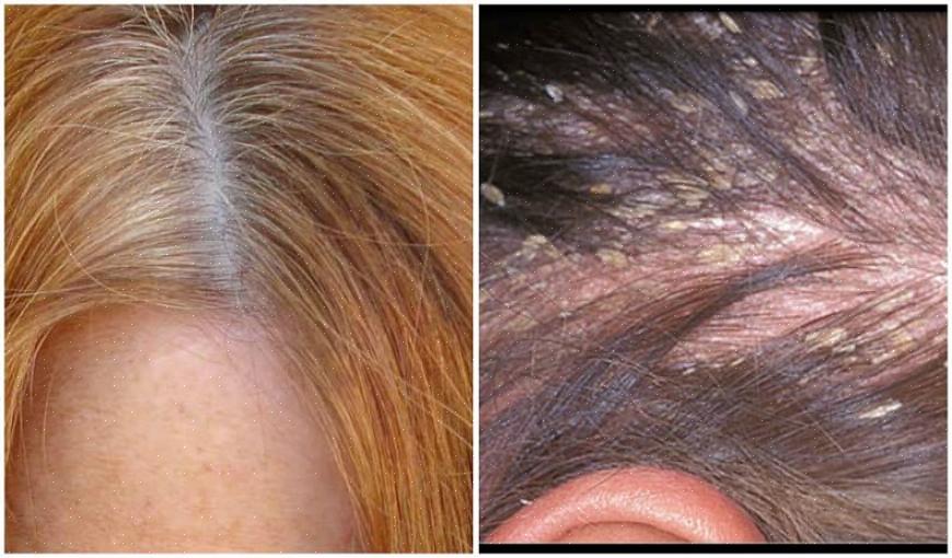Se você estiver usando algo em seu cabelo que você acha que está causando coceira no couro cabeludo