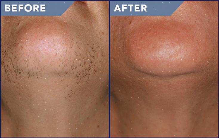 Uma boa clínica de depilação a laser levará em consideração o seu tipo de pele ao se preparar