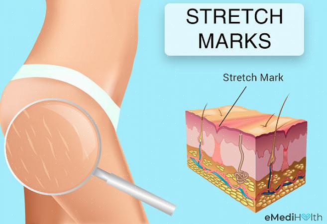 As estrias ocorrem quando a pele perde elasticidade devido à perda ou ganho repentino de peso