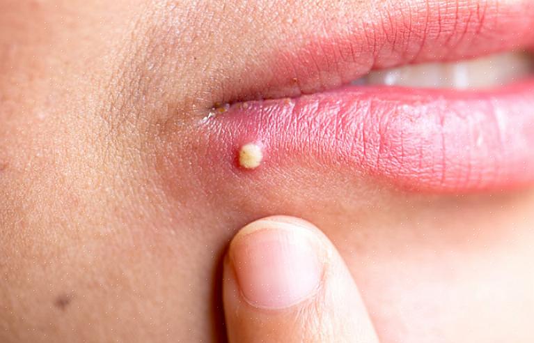 Estas são algumas maneiras de ajudá-lo a se livrar das feridas de acne