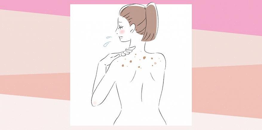 A acne nas costas é comumente conhecida como bacne