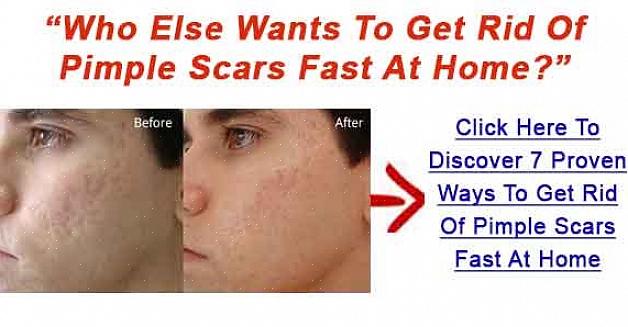 Irritantes manchas freqüentemente encontradas em seu rosto - cicatrizes de espinhas