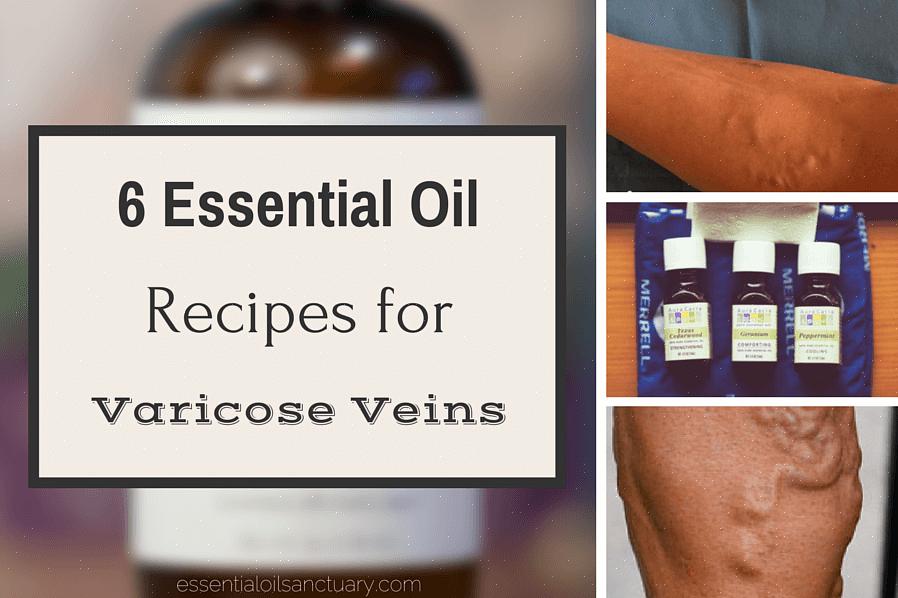 Para saber mais sobre como fazer seu próprio tratamento com óleo de massagem exclusivo para varizes