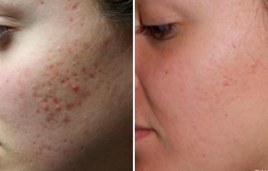 É uma doença inflamatória crônica da pele comum que deixa marcas na área afetada chamadas cicatrizes de acne