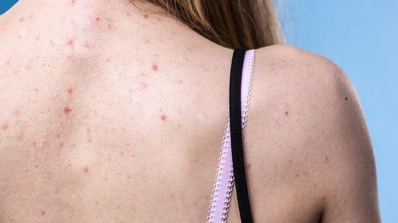 Existem muitas maneiras diferentes de tratar a acne
