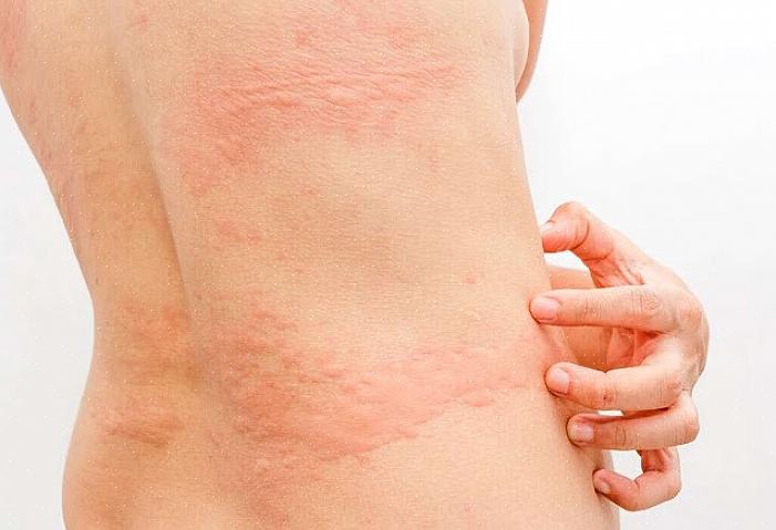 O tratamento médico adequado deve ser procurado para garantir o tratamento bem-sucedido da pele irritada