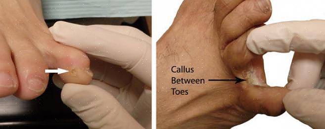 Calos moles são formações de pele espessa que geralmente ocorrem nos dedos dos pés ou entre eles