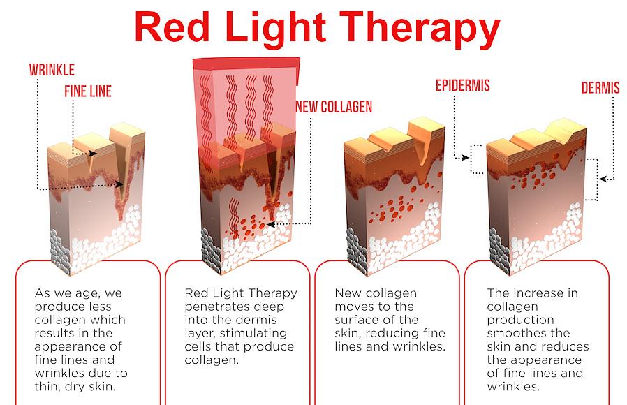 A terapia da luz vermelha ou terapia da luz é uma forma de tratamento que melhora a textura da pele da forma