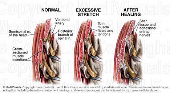 Os especialistas afirmam que o exercício após a cirurgia é um bom remédio para o tecido cicatricial interno