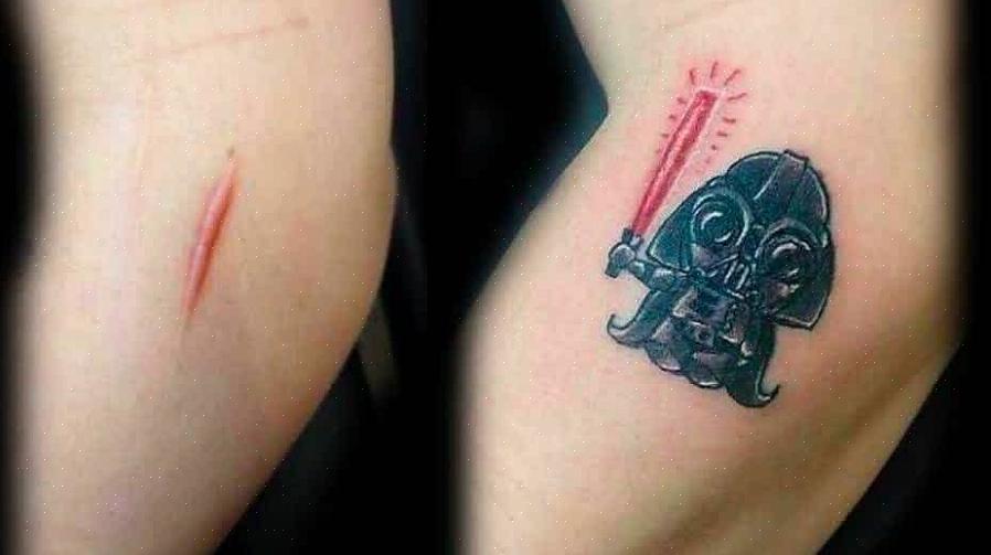 Verifique primeiro com seu médico se você pode ter sua cicatriz coberta com uma tatuagem
