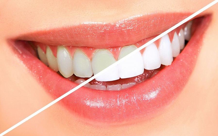 Existem muitas maneiras de fazer seus dentes parecerem mais brancos