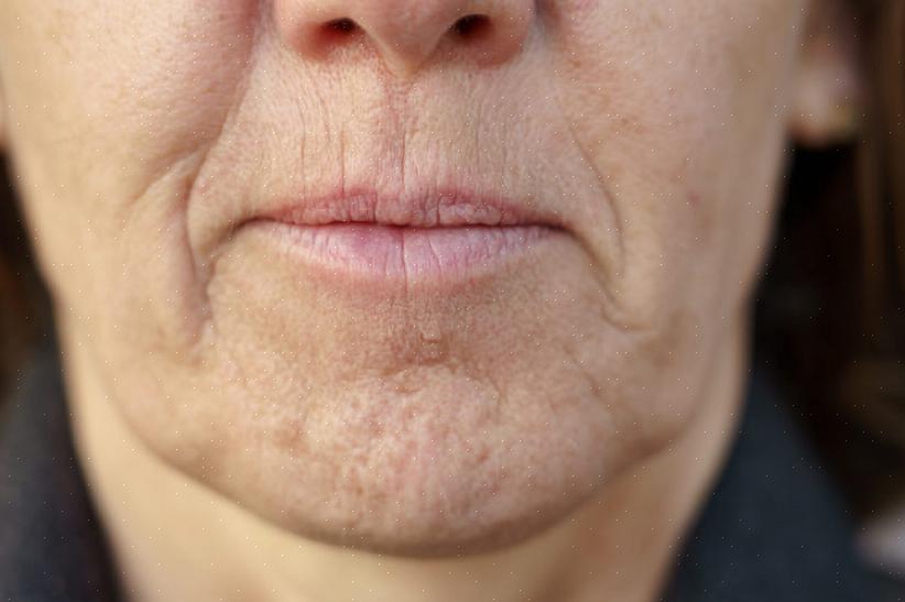A maneira mais permanente de se livrar dos pelos do rosto é a depilação a laser