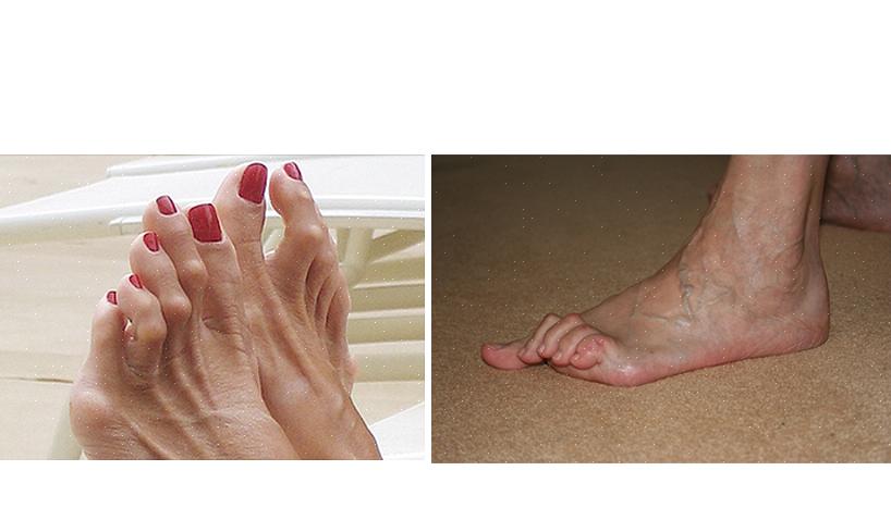 Dedos em garra é o termo usado para descrever uma deformidade no pé em que os dedos do pé da pessoa