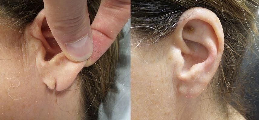 Se o tamanho do orifício do lóbulo da orelha for muito grande ou tiver cicatrizado devido ao uso prolongado