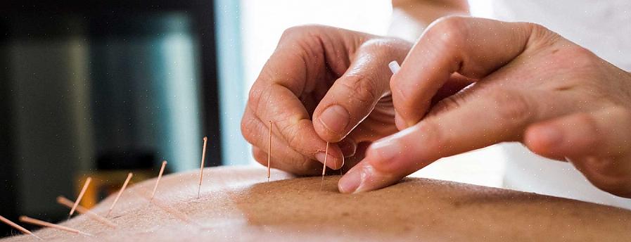 Enquanto antes eram apenas os chineses que costumavam realizar os procedimentos de acupuntura