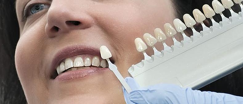 Uma faceta dentária pode fazer os dentes parecerem mais brancos